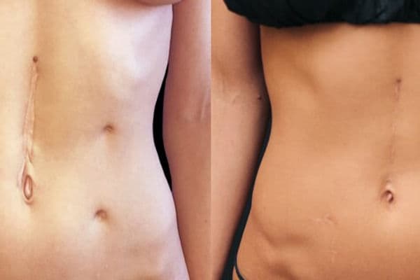 EVEN SANTA NEEDS A COMPRESSION BELT.